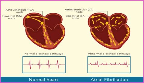 What is the difference between AF MF and AEL?